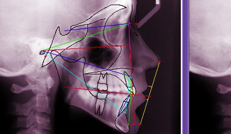 cephalometric tracing programs